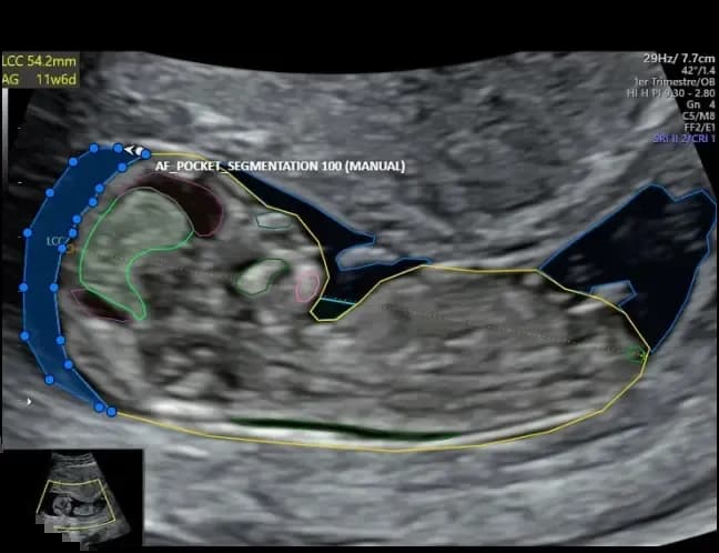 Fetal Ultrasound AI